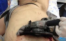 Un Brésilien fait 50 km avec une tronçonneuse dans le ventre