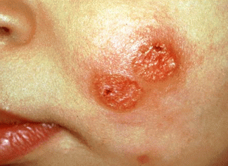 Sidi Bouzid: Hausse prévue du nombre des personnes atteintes de leishmaniose