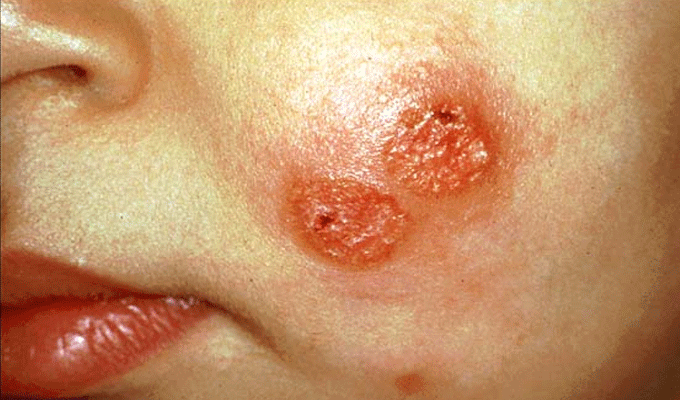 Tunisie – Kairouan: 170 cas de leishmaniose cutanée dans le gouvernorat