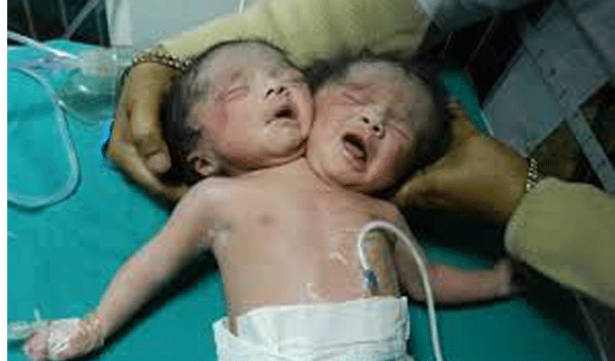 VIDEO : Naissance d’un bébé à deux têtes !