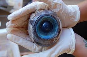 Une infirmière tente d’ôter l’oeil sain d’un patient !