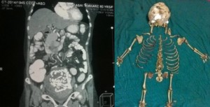 Elle a vécu 36 ans avec un squelette de bébé dans le ventre !