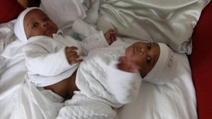 Des bébés siamois séparés à l’hôpital Necker après une très longue intervention