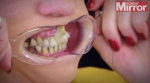 Pendant dix ans, elle se recolle les dents à la glu, pour échapper au dentiste!