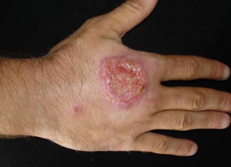 Tunisie: Tout savoir sur la polémique autour des essais thérapeutiques réalisés pour lutter contre la leishmaniose cutanée