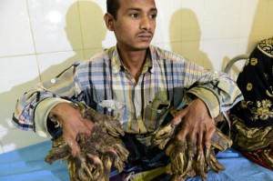 Opération réussie pour «l’homme-arbre» du Bangladesh