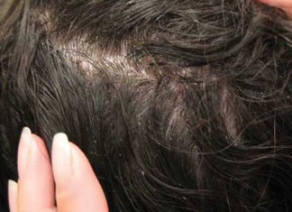 Tunisie – Jendouba : Plus de 160 cas infectés par les poux dans un collège à BouSalem
