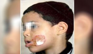 Tunisie – Jardins d’enfants: Un garçon de 4 ans brûlé au visage par son éducatrice