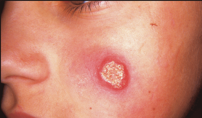 Directeur régional de la Santé à Al Masdar : 1500 cas de leishmaniose cutanée seulement à Sidi Bouzid