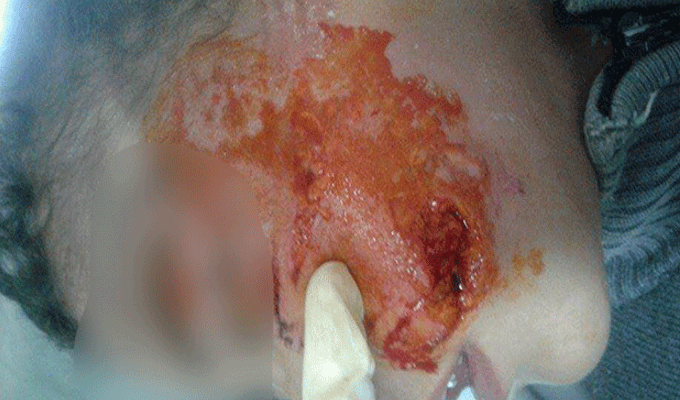 Akouda : Un chien d’attaque agresse un enfant au visage