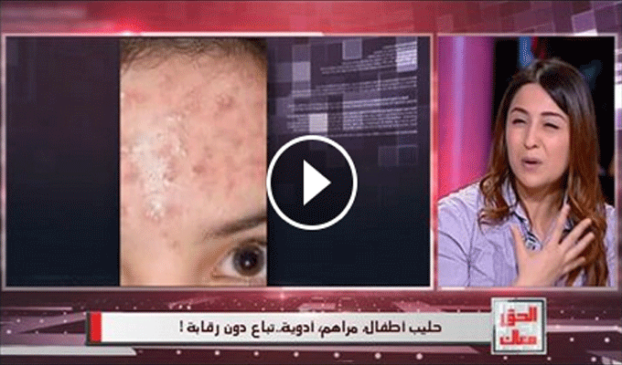 El Hak Maak : Une demoiselle presque défigurée à cause d’un produit naturel acheté en ligne, vidéo