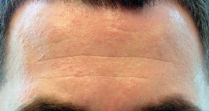 Santé : Faites attention aux rides, elles peuvent révéler un risque de maladies cardiovasculaires