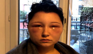 France : Une femme défigurée à cause d’une coloration pour cheveux (vidéo)