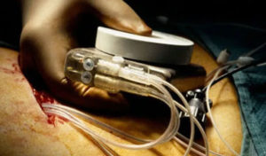 Tunisie: Les porteurs de pacemaker appelés à se présenter aux services de cardiologie