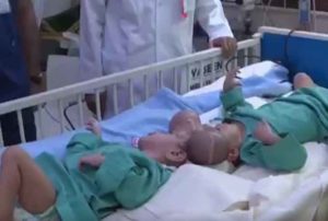 Yémen : Des médecins saoudiens séparent des jumeaux siamois (vidéo)