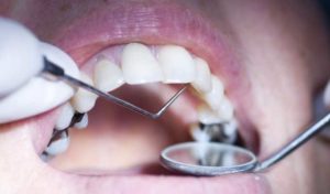 Tunisie: Interdiction du recours aux amalgames dentaires