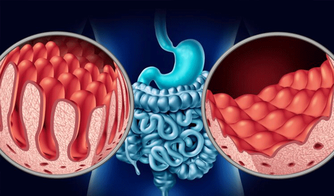 La prévalence de la maladie cœliaque en Tunisie serait d’environ 1 %