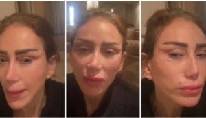 Témoignage poignant : Reham Saeed dévoile son visage défiguré après une intervention esthétique