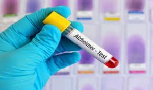 Un test sanguin révolutionnaire détecte la maladie d’alzheimer