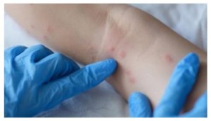 Épidémie de variole du singe : l’OMS annonce une urgence de santé publique internationale