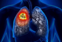 La Russie : un traitement innovant contre le cancer du poumon