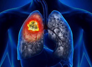 La Russie : un traitement innovant contre le cancer du poumon