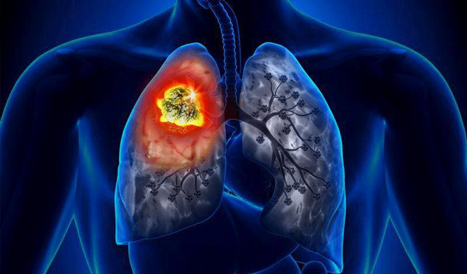 Cancer du poumon : Près de 85 % des patients ne consultent qu’à l’apparition de symptômes graves