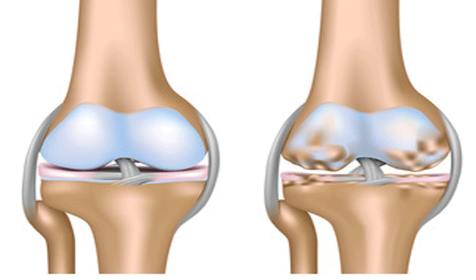 Usure du cartilage du genou : jusqu’à 40 % des plus de 45 ans concernés